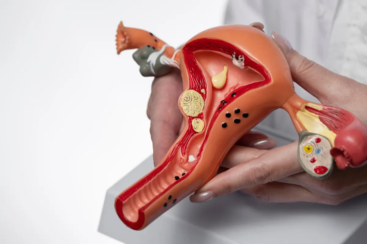 Modèle anatomique d’utérus présentant des fibromes utérins