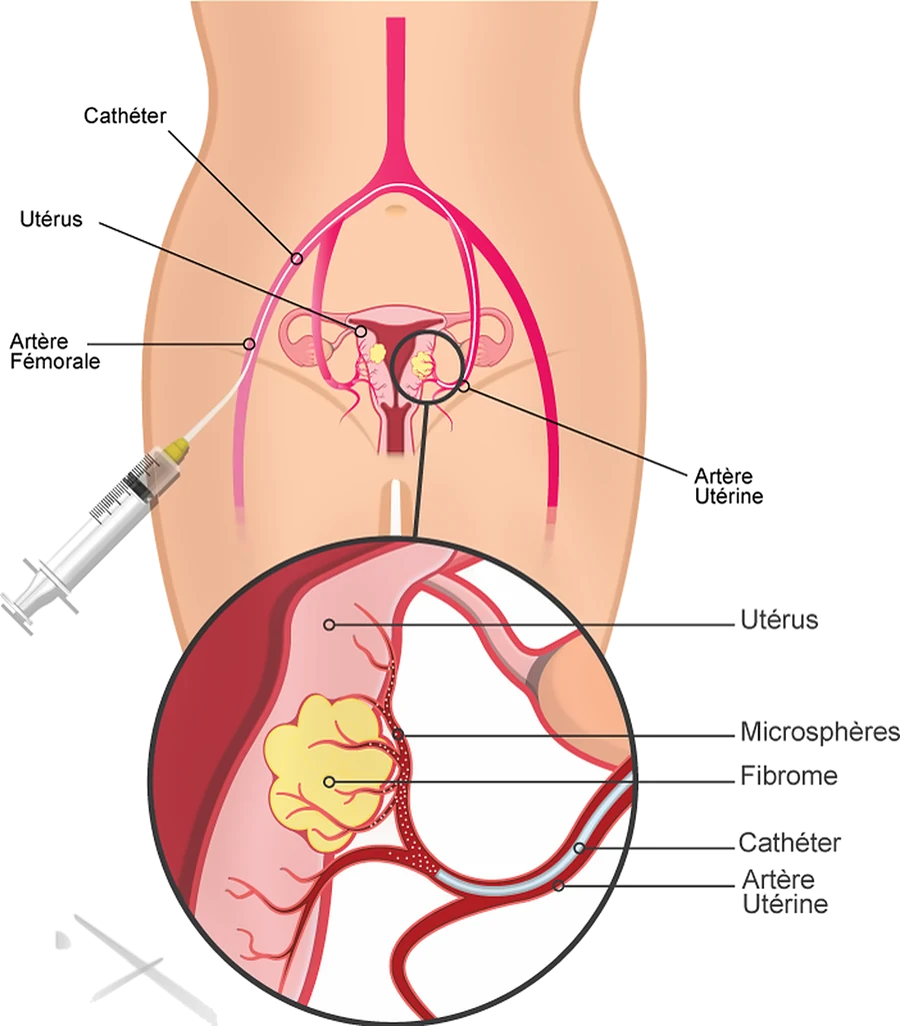 embolisation fibrome