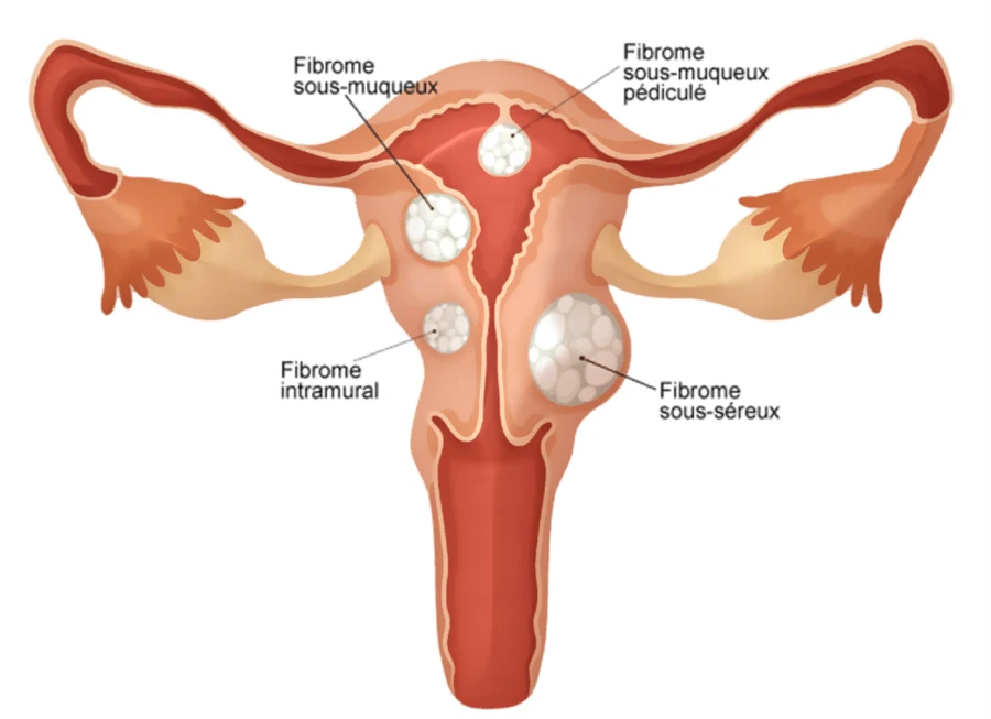 Qu'est ce qu'un fibrome ?