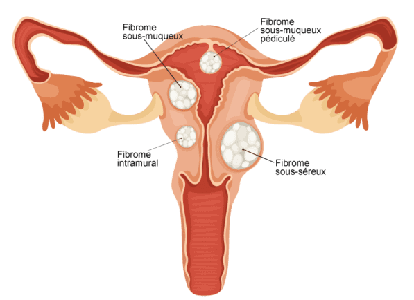 Qu'est ce qu'un fibrome ?